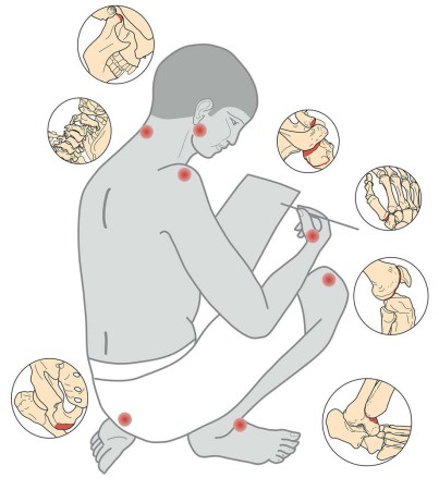 A drawing of a man crouching down and holdign a pen and paper is marked with red spots calling out where the job of an ancient Egyptian scribe caused bone damage such as arthritics. Call out circles contain darwings of the affected bones.