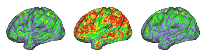 data show neural patterns before, during and after taking psilocybin